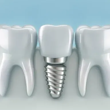 Bone Grafting