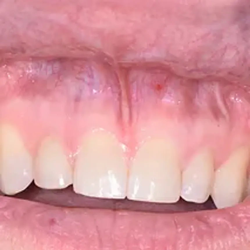 Laser Frenectomy