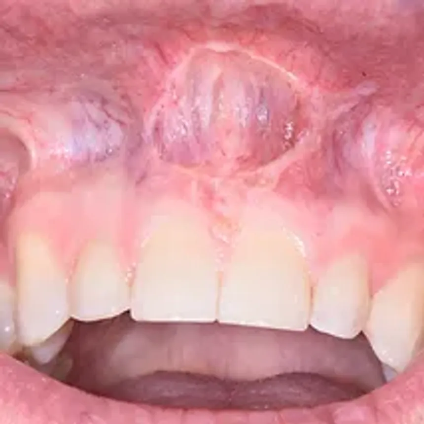 Laser Frenectomy