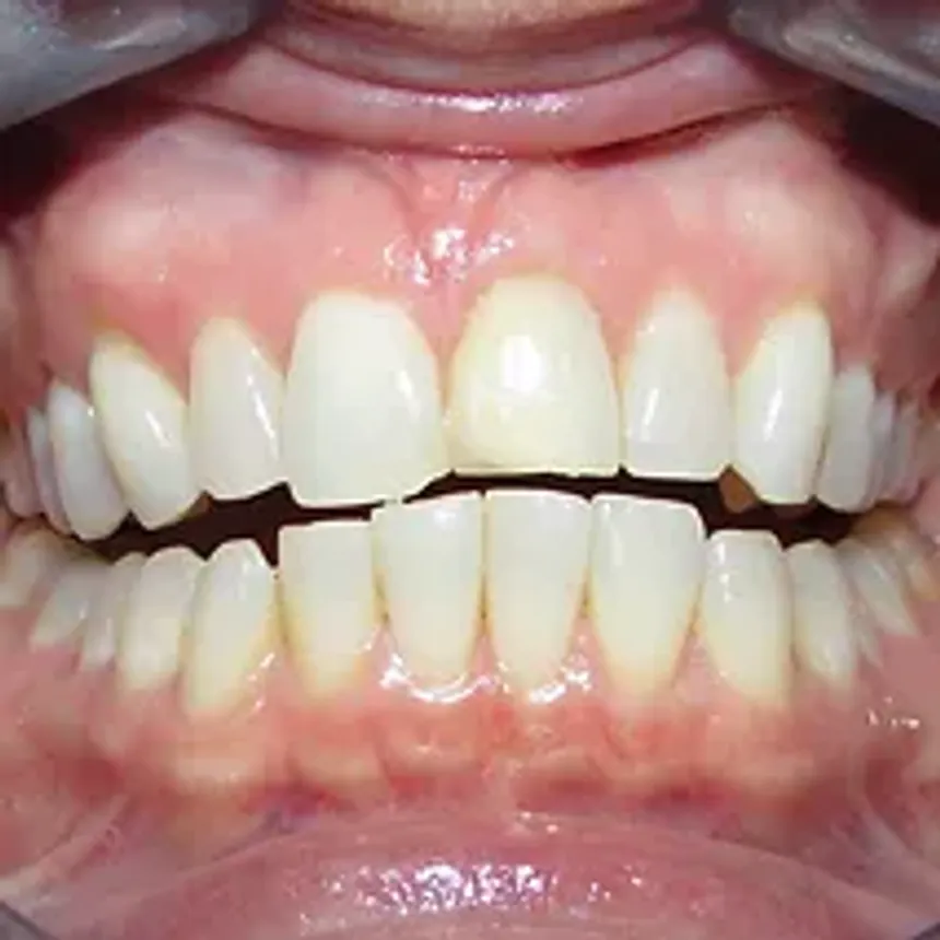 Porcelain Veneers