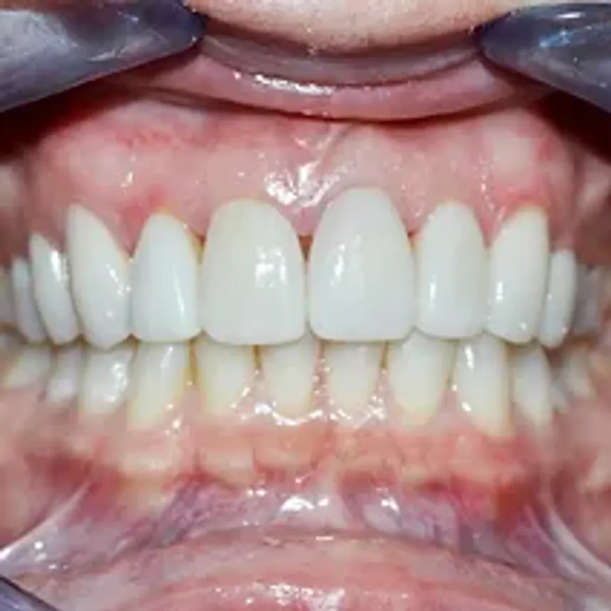 Porcelain Veneers